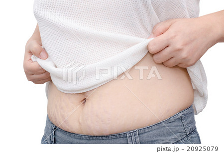 Asian woman showing her stretch marks over white Asian woman showing her stretch marks over white 20925079