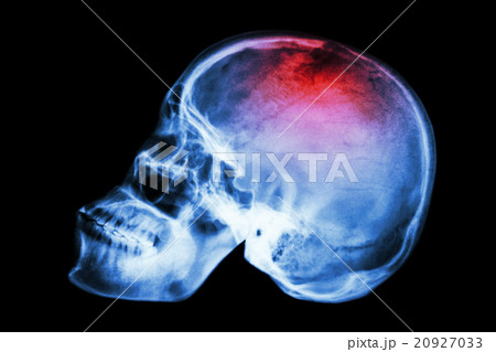 X-ray skull lateral with "Stroke" X-ray skull lateral with "Stroke" 20927033