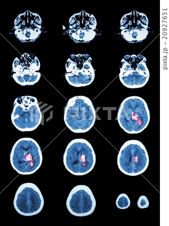 Hemorrhagic Stroke  20927651