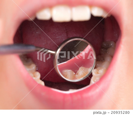 dental treatment at the dentist 20935280