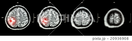 Brain tumor Brain tumor 20936908