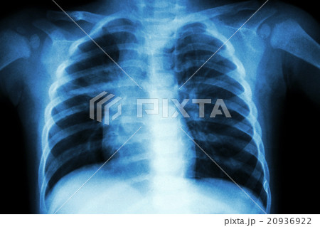 Pulmonary Tuberculosis Pulmonary Tuberculosis 20936922