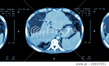 Liver cancer 20937051