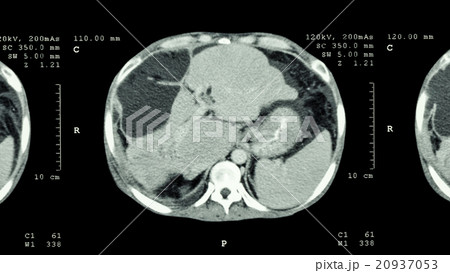 Liver cancer 20937053