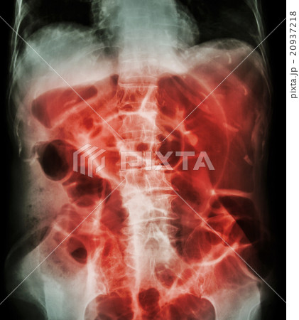 Bowel Obstruction Bowel Obstruction 20937218