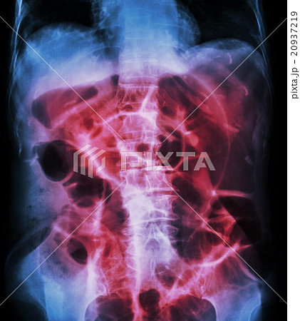 Bowel Obstruction Bowel Obstruction 20937219