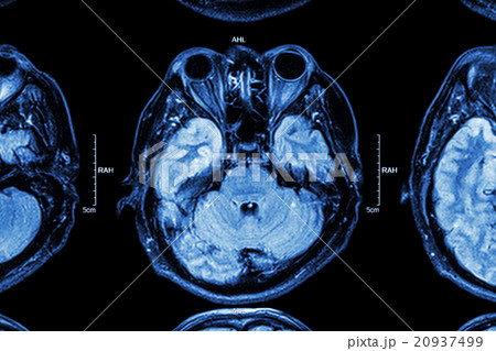 Close up of MRI brain Close up of MRI brain 20937499