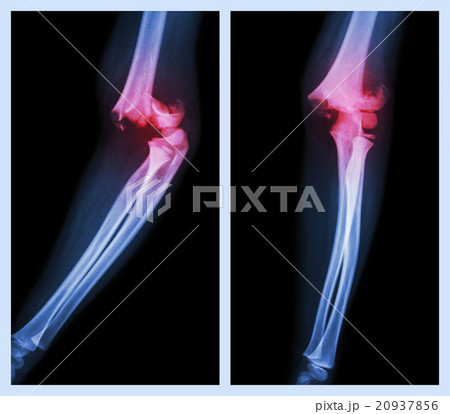 Fracture elbow  20937856