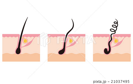 毛根の種類 くせ毛のイラスト素材