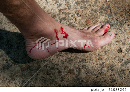 Man's bloody foot 21083245