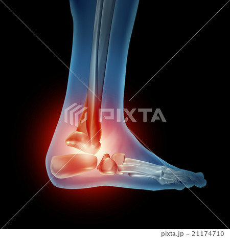 Ankle Foot Pain 21174710