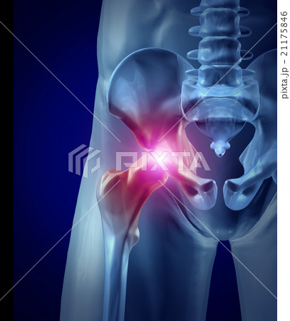 Hip Pain Hip Pain 21175846