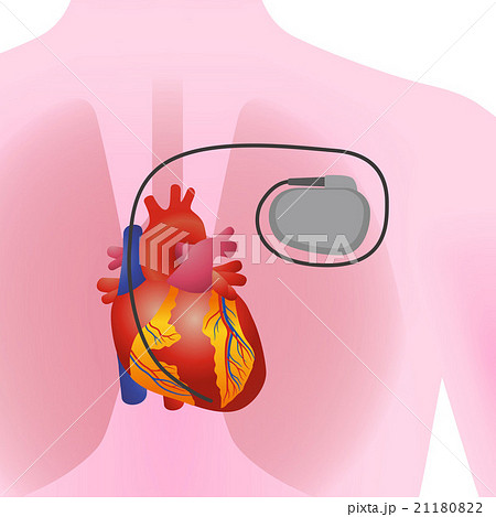 人間の心臓とペースメーカーのイラスト素材