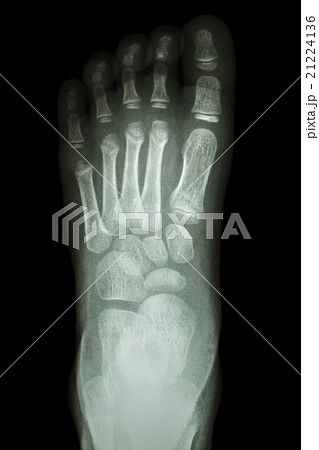 x-ray foot AP : show normal child 's foot 21224136