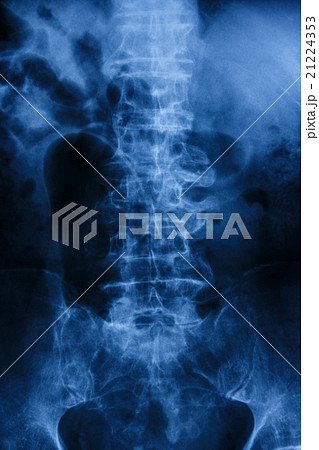 "Spondylosis" Film x-ray of lumbar spine "Spondylosis" Film x-ray of lumbar spine 21224353