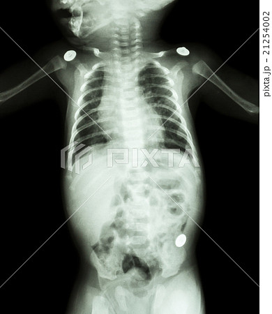Film X-ray whole body of infant 21254002