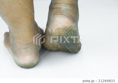 dirty foot or cracked heels isolate on white dirty foot or cracked heels isolate on white 21269833