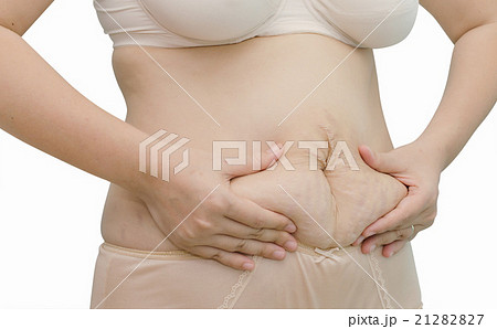 Asian woman showing her stretch marks Asian woman showing her stretch marks 21282827
