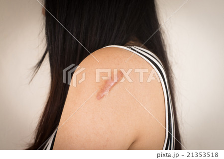 Skin lesions from allergies. Skin lesions from allergies. 21353518