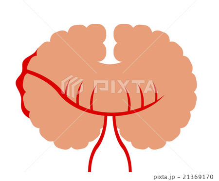 くも膜下出血 くも膜下出血 21369170