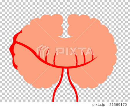 くも膜下出血 くも膜下出血 21369170