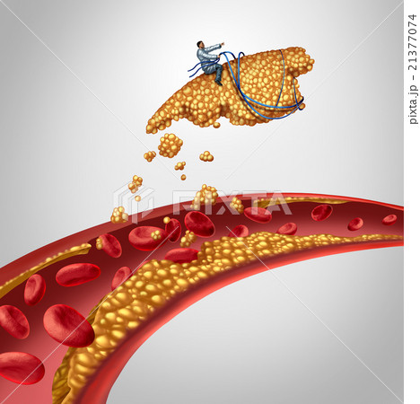 Arterial Plaque Surgery 21377074