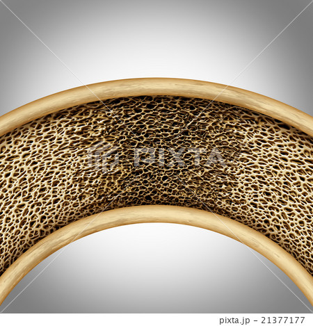 Bone Disease Concept 21377177