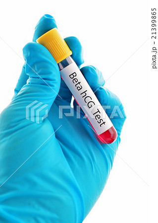 Beta hCG test Beta hCG test 21399865