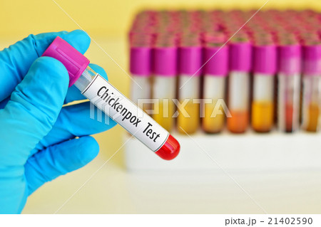 Chickenpox test 21402590