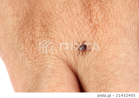 Tick crawling on human skin 21432405