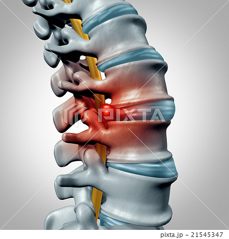 Herniated Disk 21545347