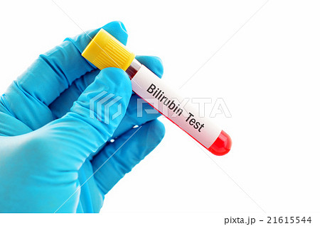 Bilirubin test 21615544