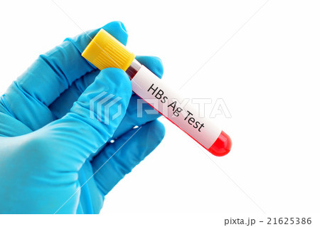 HBsAg (hepatitis B virus) test 21625386