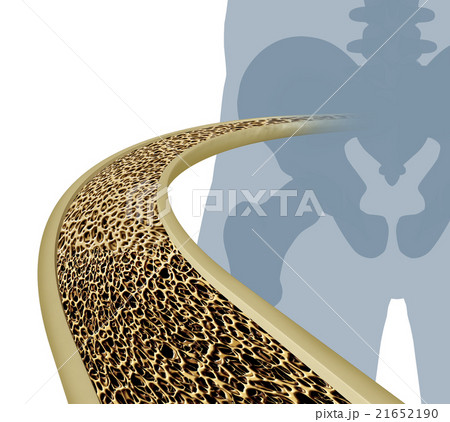 Osteoporosis Medical Illustration 21652190