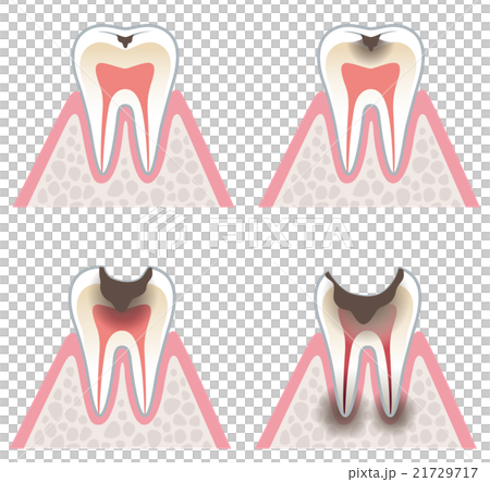 虫歯の進行 虫歯の進行 21729717