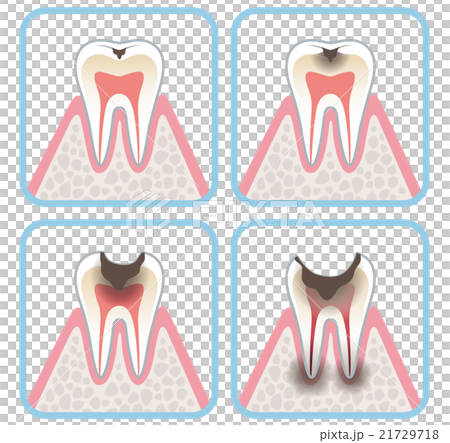 齲齒進展 21729718