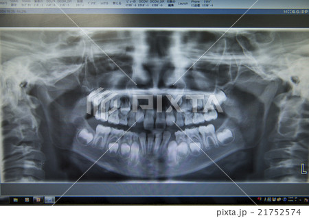 歯のデジタルレントゲン写真 21752574