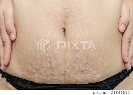 Close up stretch marks on Asian woman belly 21844610