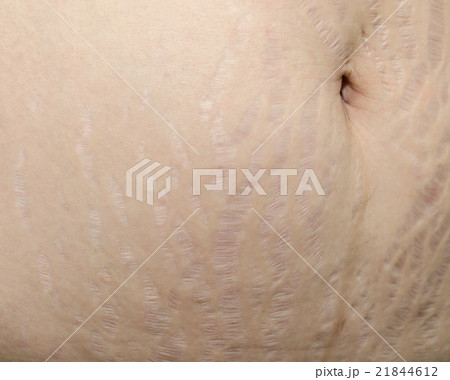 Close up stretch marks on Asian woman belly 21844612