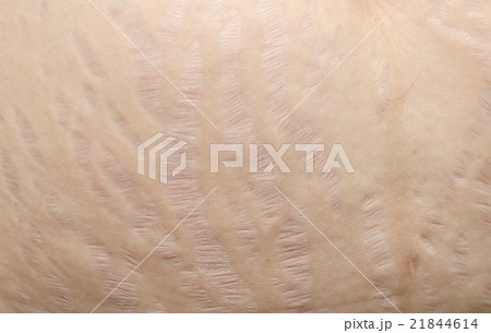 Close up stretch marks on Asian woman belly 21844614