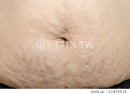 Close up stretch marks on Asian woman belly 21844616