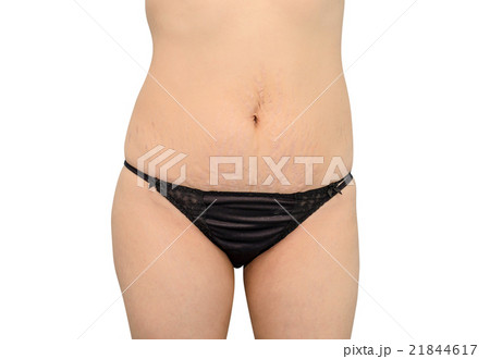 woman in black underwear showing her stretch marks 21844617