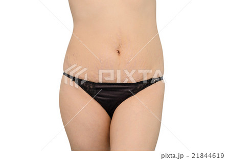 woman in black underwear showing her stretch marks 21844619
