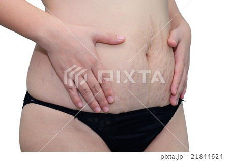 Close up stretch marks on Asian woman belly 21844624