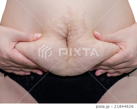 Close up stretch marks on Asian woman belly 21844626