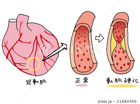 動脈硬化の血管と心臓 文字ありのイラスト素材