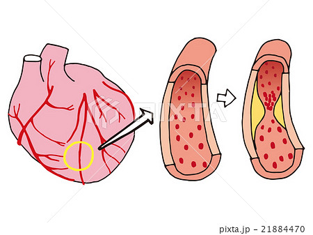 動脈硬化の血管と心臓 文字なしのイラスト素材