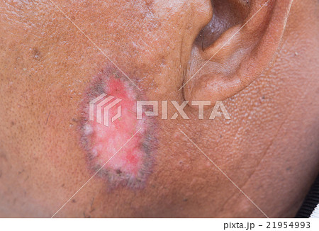 Skin disorder 21954993