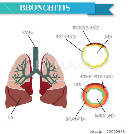 Healthy and inflamed bronchus. Chronic Bronchitis. Healthy and inflamed bronchus. Chronic Bronchitis. 22000928