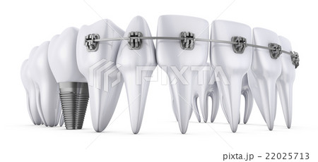 teeth and implant 22025713